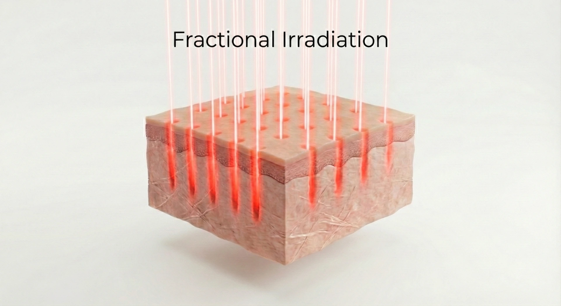 フラクショナルレーザー照射によるシミ取り