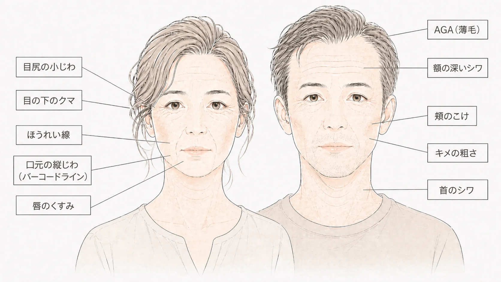 スモーカーズフェイスの特徴を示すイラスト ─ 男女の顔に現れるしわ・くすみ・色素沈着などの解説図