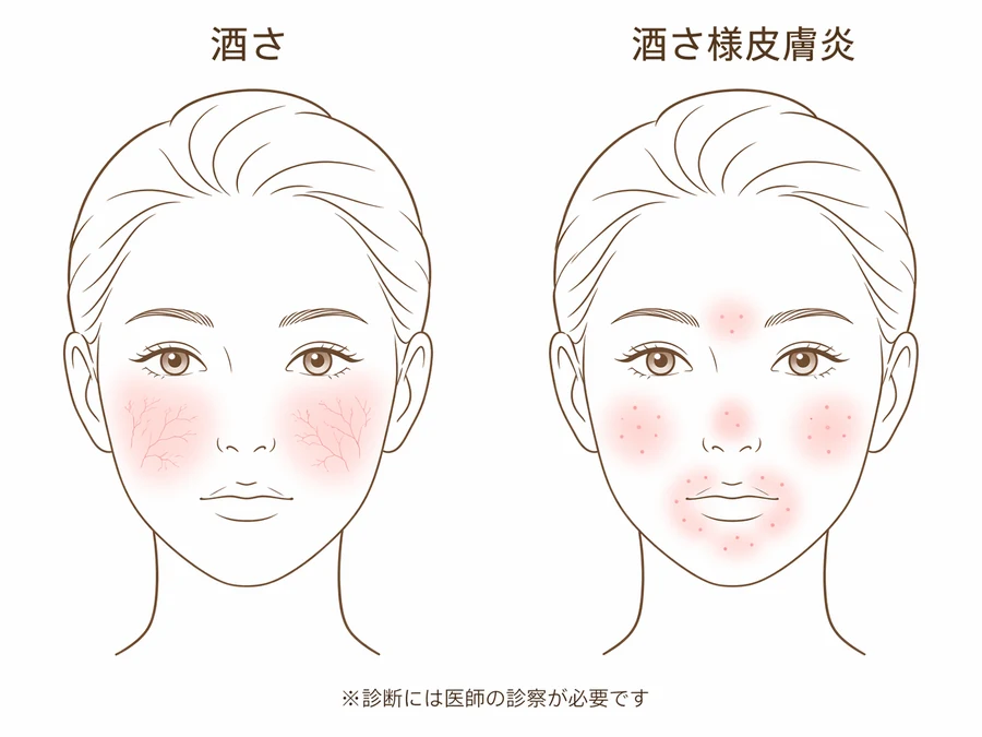酒さと酒さ様皮膚炎の症状分布の違いを示した比較模式図。左の酒さは両頬中心の広い紅斑と毛細血管拡張、右の酒さ様皮膚炎は頬・口周り・鼻・眉間の限局した赤みと点状の丘疹