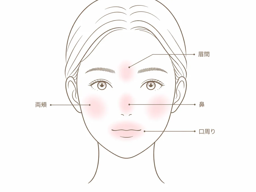酒さ様皮膚炎で赤みが出やすい顔の部位（両頬・鼻・眉間・口周り）を示した線画の模式図