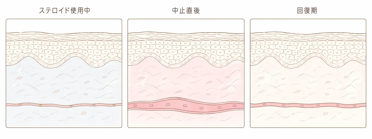 ステロイド外用中・中止直後・回復期における皮膚血管の太さの変化を示した3コマの模式図。使用中は血管が細く、中止直後は拡張して赤みが広がり、回復期には元に戻る