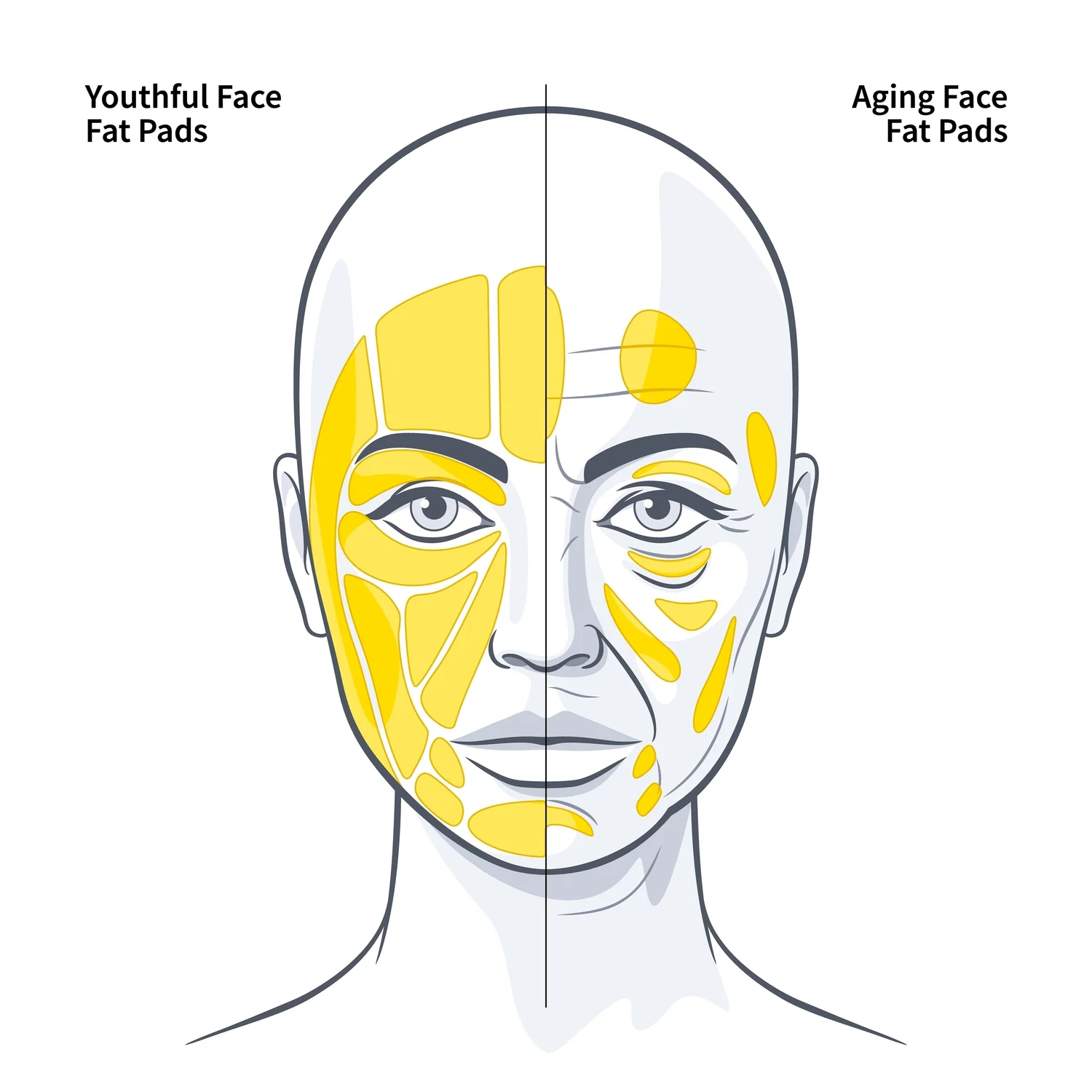 顔の表在性脂肪パッドの加齢変化（Youthful FaceとAging Faceの比較解剖イラスト）