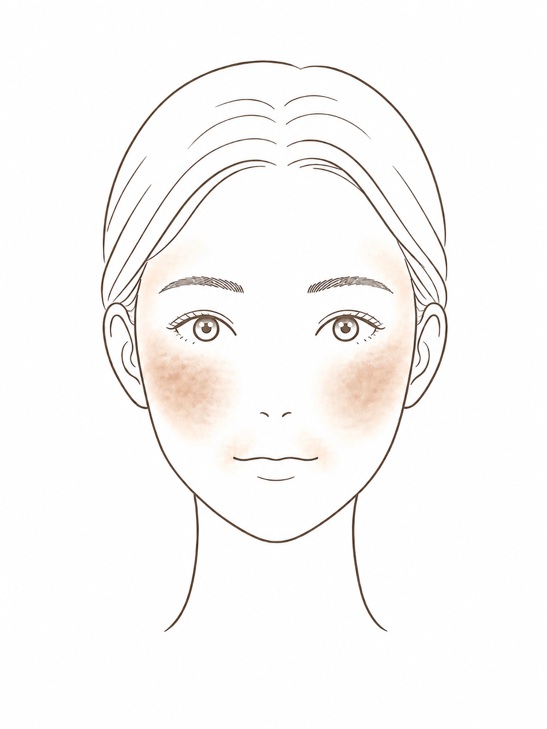 肝斑：両頬や額に左右対称に広がる薄い茶色のシミの典型像