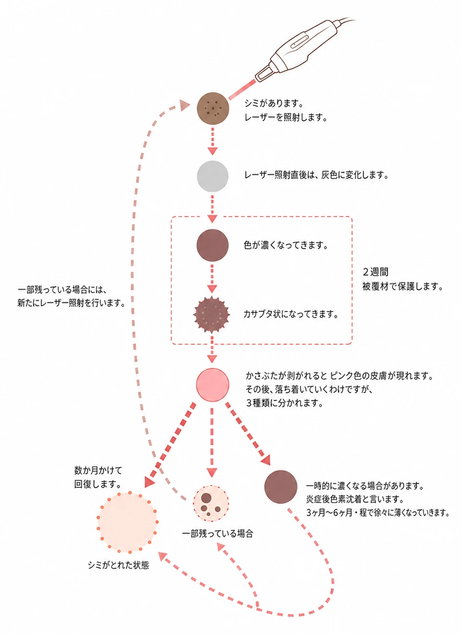 シミのレーザー治療（スポット照射）後の経過図