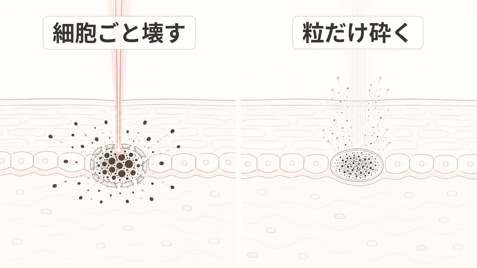 レーザートーニングの作用機序の比較イラスト。左は高出力で色素細胞ごと壊すイメージ、右は低出力で色素の粒だけを砕き細胞は温存するイメージ。色素細胞は表皮の基底層に描かれている。