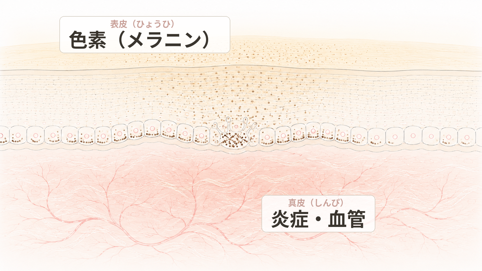 肝斑の肌の断面イラスト。上の表皮の基底層に色素（メラニン）があり、下の真皮に慢性的な炎症と増えた毛細血管が広がる。