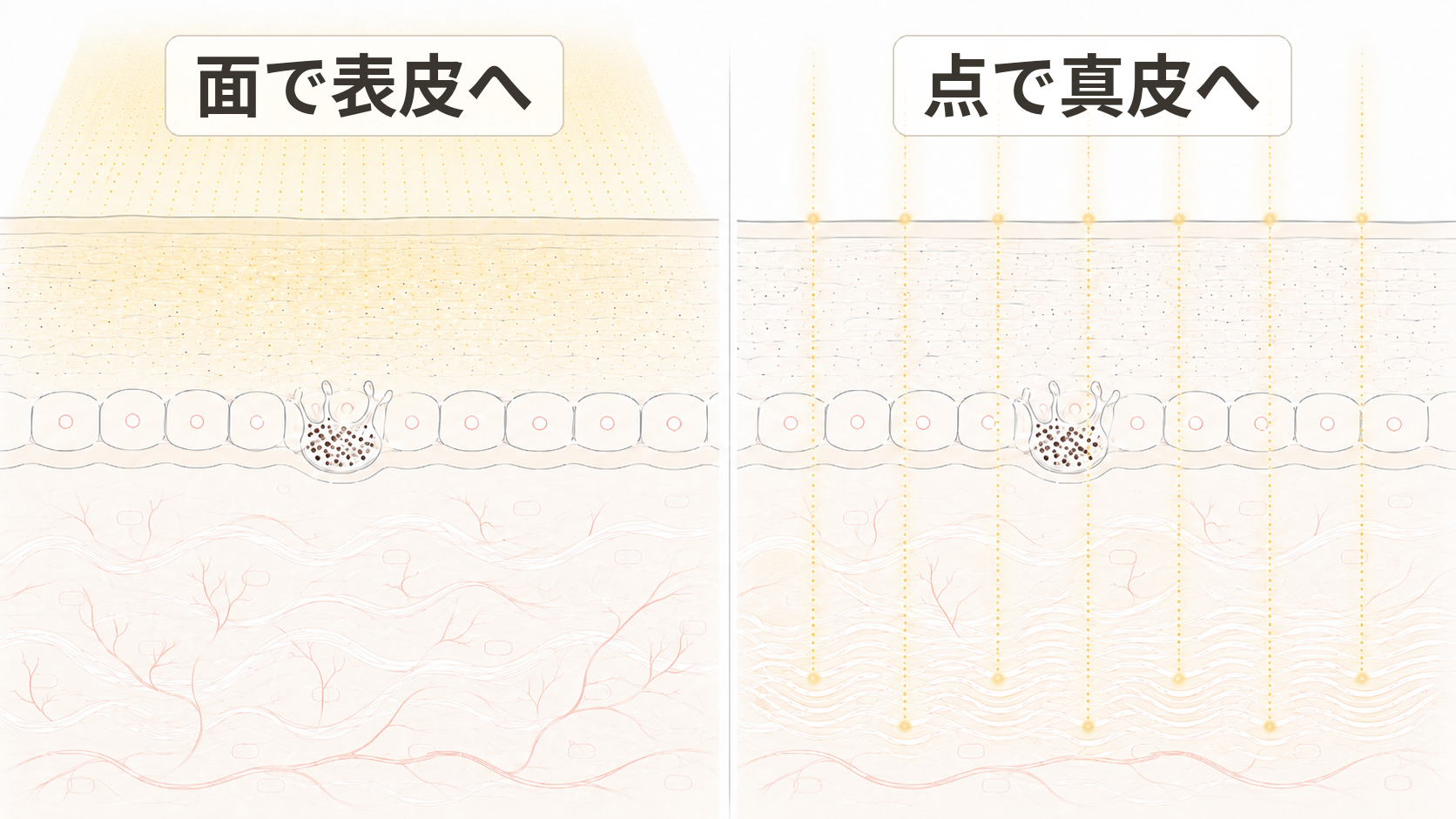 レーザーの届く深さを比べた肌の断面イラスト。左は面トーニングで幅広い光が表皮を中心に浅く届く。右はフラクショナルピコで細い光の柱が点状に真皮の深くまで届く。色素細胞は表皮の基底層に描かれている。