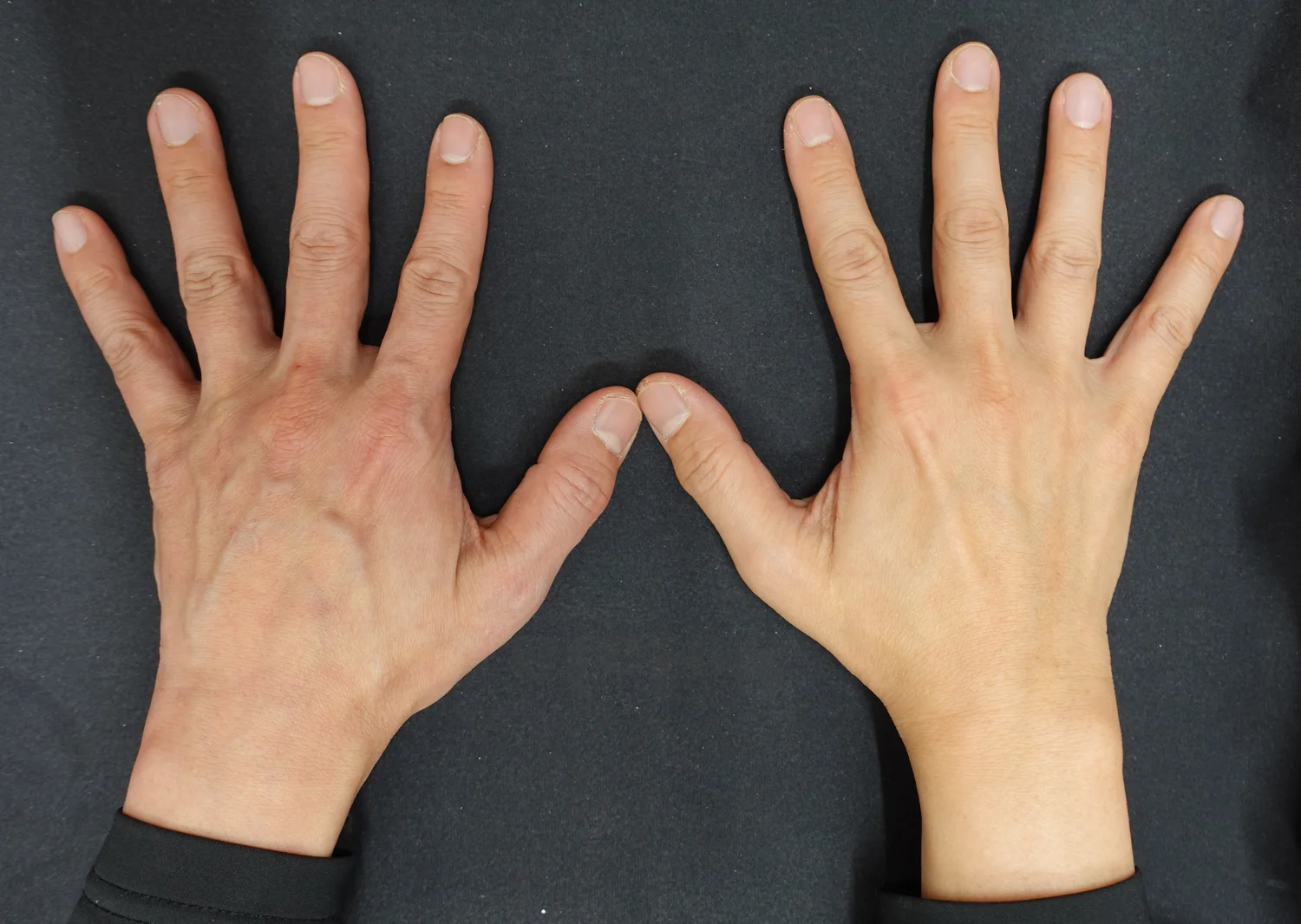 手の甲の若返り治療の症例写真 ジュベルック+ミラジェット 右手のみ3回治療