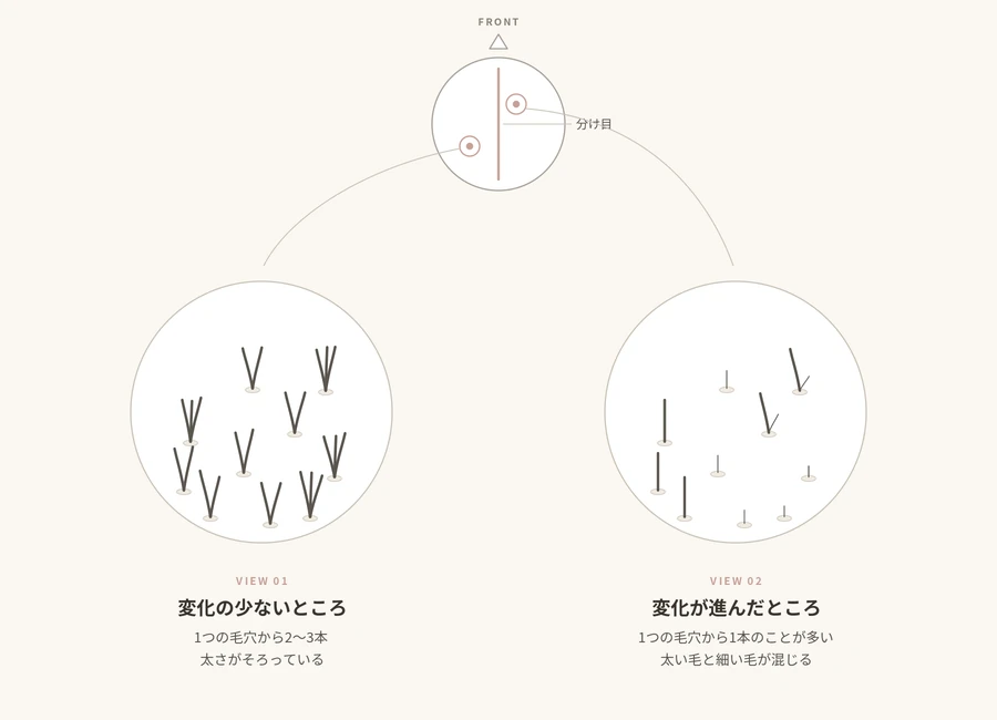 頭皮を拡大したときの模式図。左は1つの毛穴から2〜3本が生えて太さがそろっている状態、右は1つの毛穴から1本のことが多く、太い毛と細い毛が混じっている状態