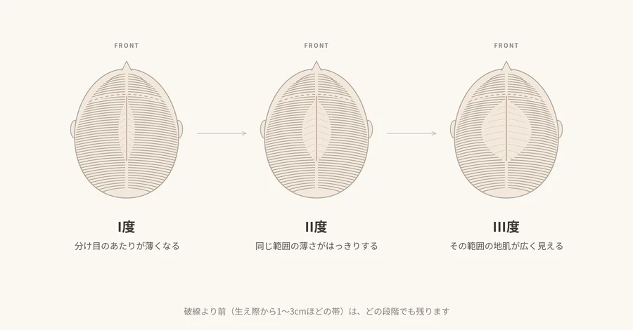 頭部を上から見た模式図。Ludwig分類のI度・II度・III度が並び、分け目を中心とした薄い範囲が段階的に広がる。いずれの段階でも生え際から1〜3cmほどの帯は残る