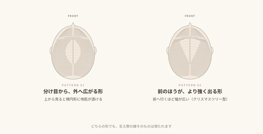 頭部を上から見た模式図。左は分け目から外へ楕円形に広がる形、右は前へ行くほど幅が広くなるクリスマスツリー型