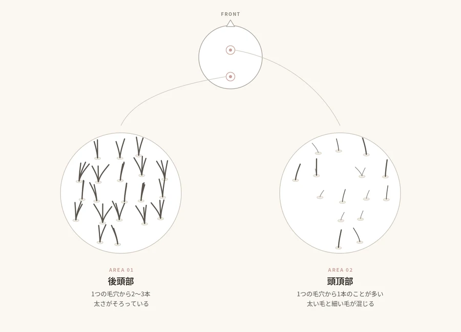 頭皮を拡大した後頭部と頭頂部の比較図。後頭部はひとつの毛穴から2〜3本が生え太さがそろい、頭頂部は1本のことが多く太い毛と細い毛が混じる