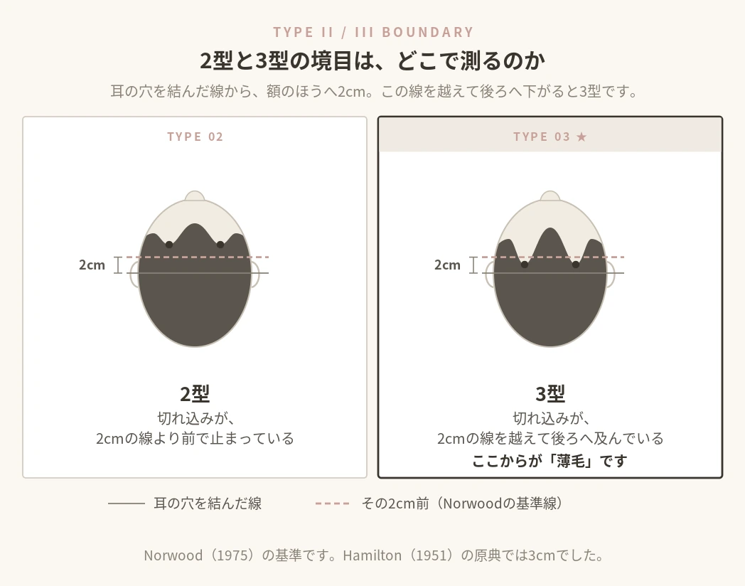 ハミルトン・ノーウッド分類で2型と3型を分ける基準線を示した図。耳の穴の高さを通る線から前方2センチの位置に基準線があり、生え際の切れ込みがこの線を越えて後方へ及ぶと3型になる