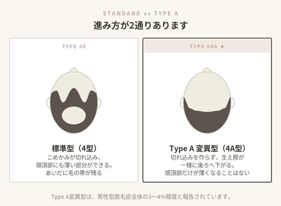 ハミルトン・ノーウッド分類の標準型とType A変異型の違いを頭の上から見て比べた図