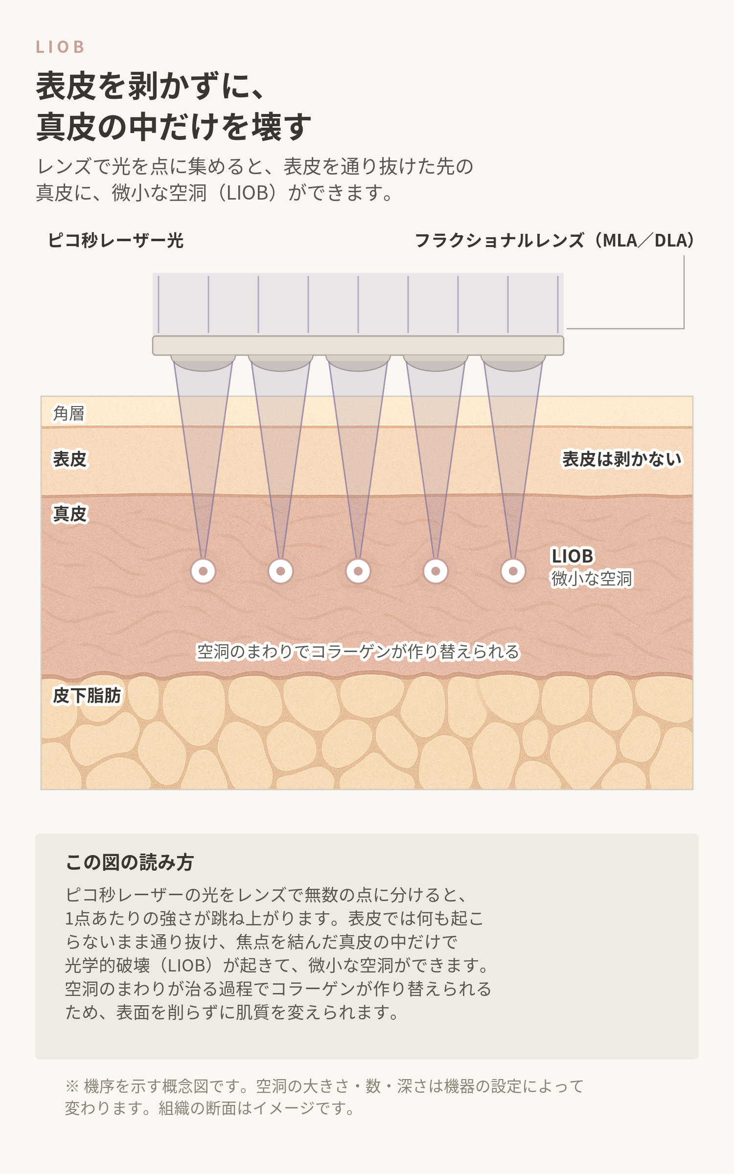 LIOBの概念図。ピコ秒レーザーの光をフラクショナルレンズ(MLA/DLA)で点に分けると、表皮を通り抜けた先の真皮に微小な空洞