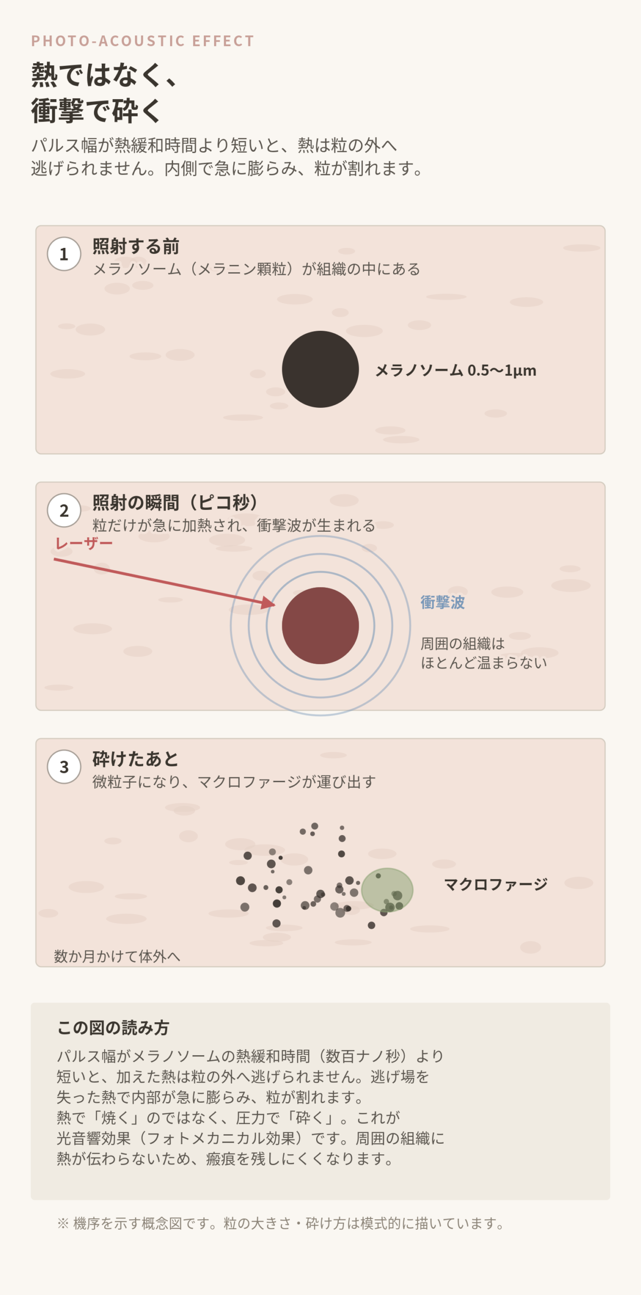 光音響効果によるメラニン顆粒の破砕を3段階で示した概念図。照射前のメラノソーム、照射の瞬間に粒だけが加熱され衝撃波が生まれる様子