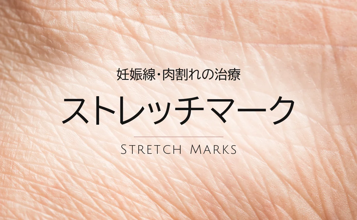 ストレッチマーク（妊娠線・肉割れ）の治療｜ソララクリニック（仙台）