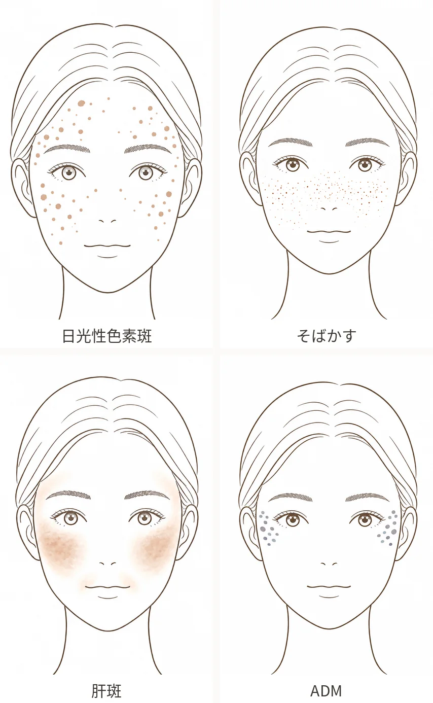 シミの種類による出方の違いのイラスト(日光性色素斑、そばかす、肝斑、ADM)