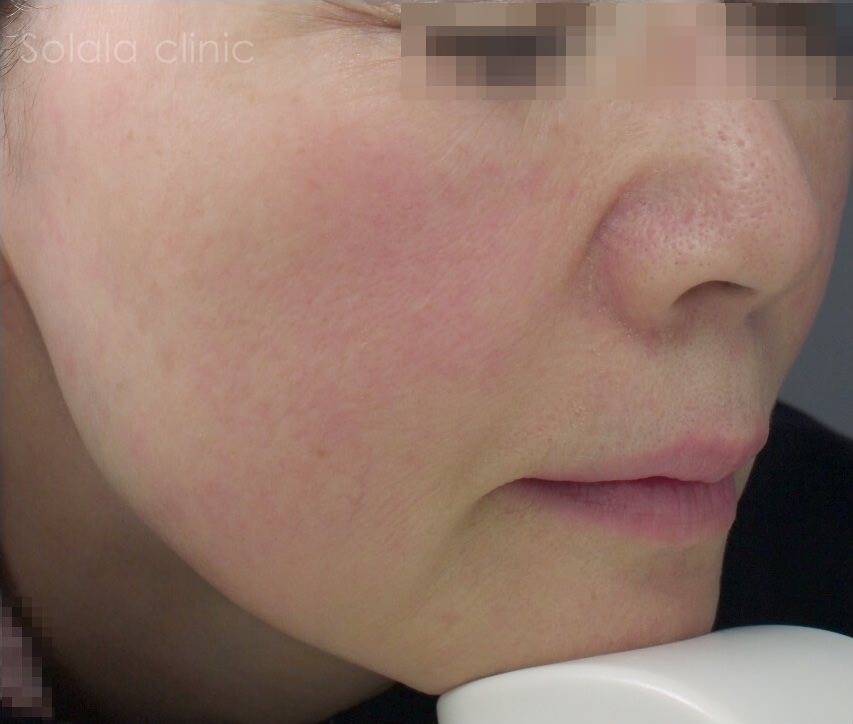 50代女性 フォトナ6D 治療後