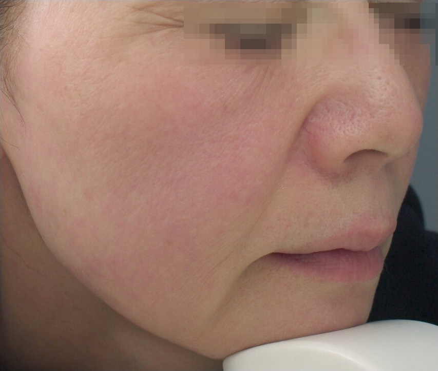 50代女性 フォトナ6D 治療前
