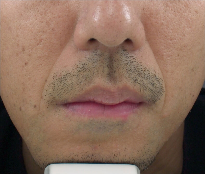 50代男性 フォトナ6D 治療前